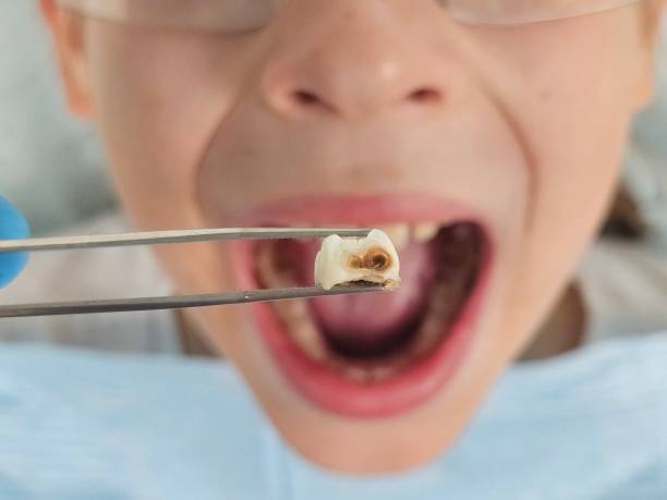 Best Urgent Tooth Repair  in Bon Secour, AL